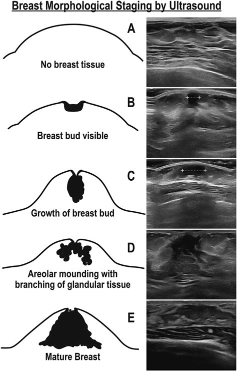 teen girl boobs|Normal Breast Development and Changes